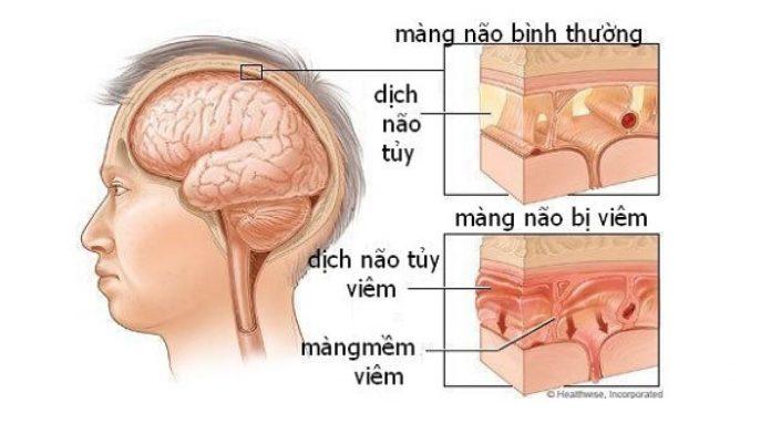 Viêm Màng Não