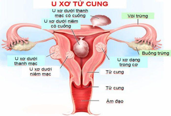 Cách Nhận Biết U Nang Tử Cung Sớm Nhất Bạn Nên Biết